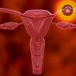 Ciąża pozamaciczna (ektopowa)