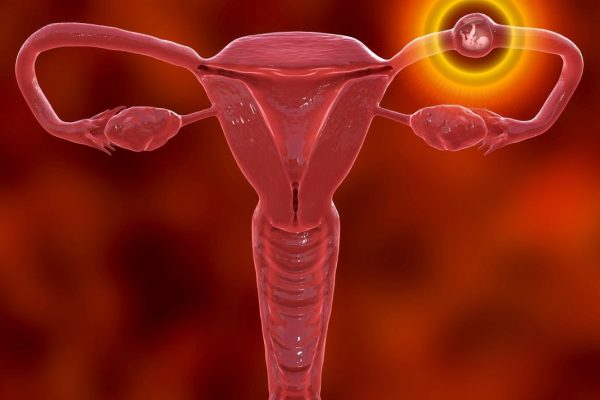 Czym jest ciąża pozamaciczna (ektopowa)
